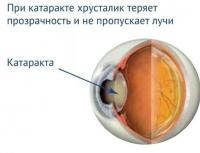 Профилактика катаракты глаза — медикаментозные и народные средства
