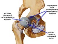 Симптомы и лечение артроза тазобедренного сустава, суть заболевания Стерся тазобедренный сустав что делать