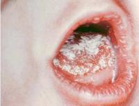 Виды дрожжевого грибка у детей и методика его лечения Формы и стадии заболевания